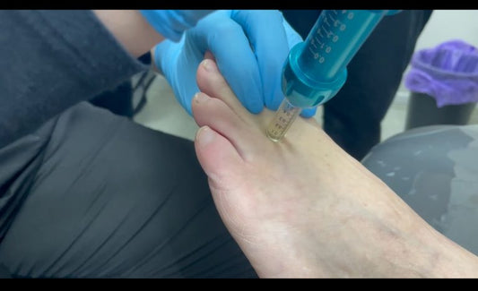 Revolutionising Plantar Wart Treatment with Comfort-in Needle free Jet Injector