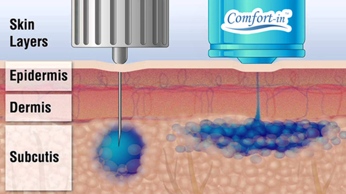 Needles vs Comfort-in needle-free insulin injection system