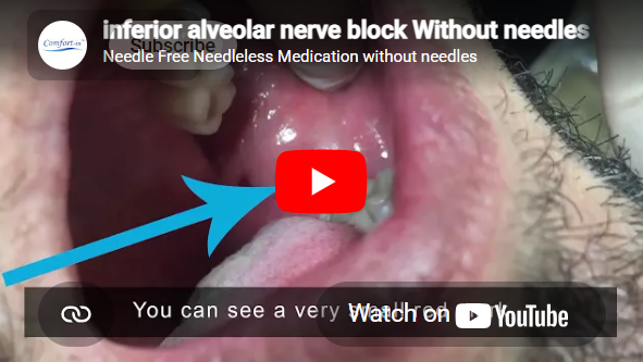 Load video: inferior alveolar nerve block Without needles using the Comfort-in™️